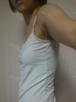 No longer a pre-teen body — Korea cost, reviews & before-after | MISOODA