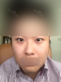 rhinoplasty (ear cartilage, silicone), ptosis correction and lateral canthoplasty — Korea cost, reviews & before-after | MISOODA