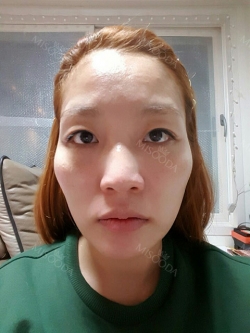 Operation : facial contouring (malar, chin, square jaw), nose — Korea cost, reviews & before-after | MISOODA