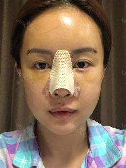 Operation: Nose — Korea cost, reviews & before-after | MISOODA