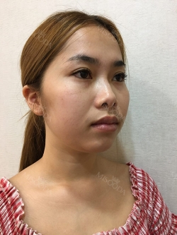 Non-Silicone Implant Nose Surgery (ribs -> rib cartilage), mandibular implants — Korea cost, reviews & before-after | MISOODA