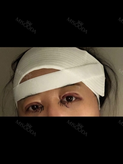 Girin: facial contouring, acculift, rhino, forehead lift, des, epi, fat graft — Korea cost, reviews & before-after | MISOODA