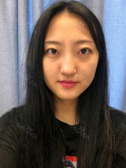 Double Eyelid + Rhinoplasty + Fat Graft — Korea cost, reviews & before-after | MISOODA