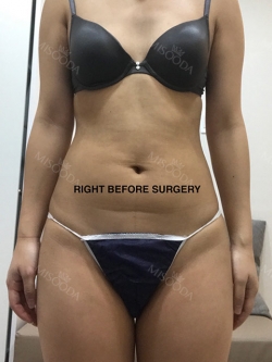 Liposuction and Breast Augmentation — Korea cost, reviews & before-after | MISOODA