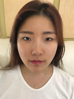 Eye surgery has succeeded in the way different image — Korea cost, reviews & before-after | MISOODA