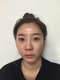 Goodbye button nose! — Korea cost, reviews & before-after | MISOODA