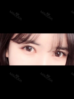 [Eyes surgery] Double eyelids plasty with incision, reoperation+upper cantho plasty+lateral cantho plasty+lower lateral cantho plasty — Korea cost, reviews & before-after | MISOODA