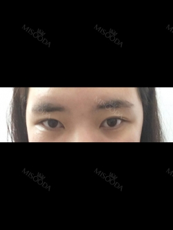 [Eyes surgery] Double eyelids plasty with incision, reoperation+upper cantho plasty+lateral cantho plasty+lower lateral cantho plasty — Korea cost, reviews & before-after | MISOODA