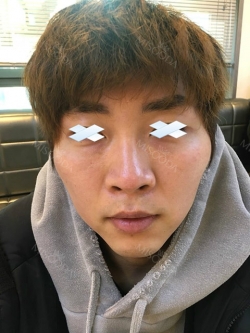 [Contouring Plastic Surgery] I believe it’s the best plastic surgery for men. — Korea cost, reviews & before-after | MISOODA