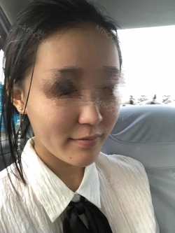Two jaw surgery in South Korea — Korea cost, reviews & before-after | MISOODA