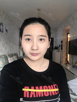 Cheekbone Reduction & V-Line Surgery — Korea cost, reviews & before-after | MISOODA