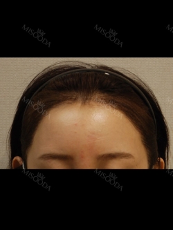 Hairline transplant surgery (after 7 months) — Korea cost, reviews & before-after | MISOODA