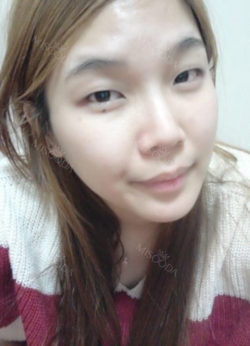 Sparkly eyes! — Korea cost, reviews & before-after | MISOODA