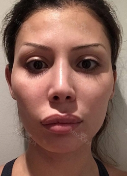 Upper lip reduction, cheek bone, square jaw reduction, fat grafting — Korea cost, reviews & before-after | MISOODA