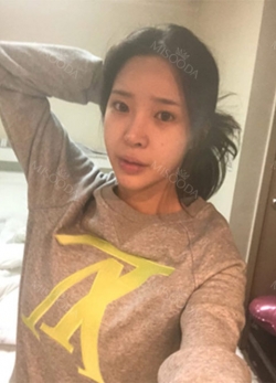 Endotine thread lifting, Epicanthoplasty, Nose revision surgery, lip tip lift — Korea cost, reviews & before-after | MISOODA