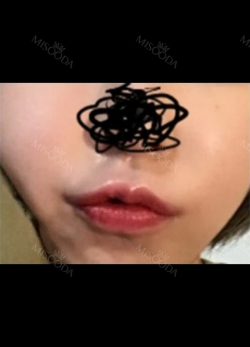 I wanted to have smile lifting surgery — Korea cost, reviews & before-after | MISOODA
