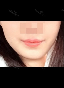 I really recommend it to those who have flat lips like me. — Korea cost, reviews & before-after | MISOODA