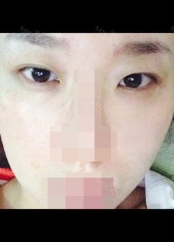 Incision Ptosis Revision — Korea cost, reviews & before-after | MISOODA
