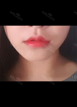 I had Smile lip lifting, Cupid’s bow lip and lip tubercle surgeries in Hyundai Aesthetics. — Korea cost, reviews & before-after | MISOODA