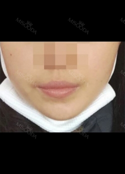 I really recommend it to those who have flat lips like me. — Korea cost, reviews & before-after | MISOODA