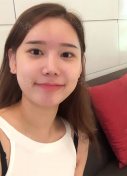Incision Ptosis, Nose Revision, Cheek Bone, Square Jaw, Thread Lifting, Buccal Fat Removal — Korea cost, reviews & before-after | MISOODA
