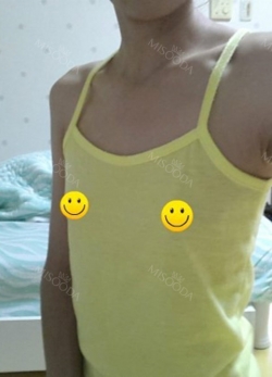 164 44 65A teardrop implants 275 C cup + Nose (lo) — Korea cost, reviews & before-after | MISOODA