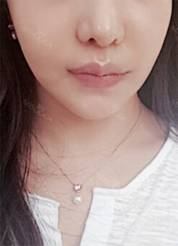 Philtrum Reduction, Lovely Smile Balanced, Cupid’s bow lip Surgery — Korea cost, reviews & before-after | MISOODA