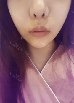 Philtrum Reduction, Lovely Smile Balanced, Cupid’s bow lip Surgery — Korea cost, reviews & before-after | MISOODA