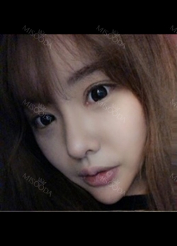 Double eyelid revision, Nose revision, Facial Liposuction, Face Fat Grafting — Korea cost, reviews & before-after | MISOODA