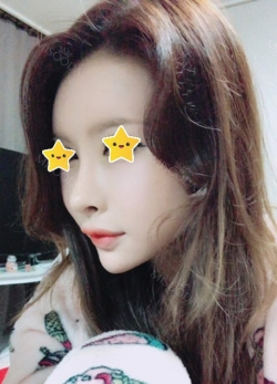 I did rehab surgery on my nose. — Korea cost, reviews & before-after | MISOODA
