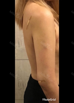 Arm Liposuction with Pretty Body Clinic — Korea cost, reviews & before-after | MISOODA