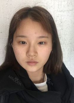 Dual Epi + Nasap Tip Correction + Lip Filler — Korea cost, reviews & before-after | MISOODA