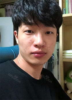 Nasal bridge+Nasal tip surgery / used nasal septum — Korea cost, reviews & before-after | MISOODA