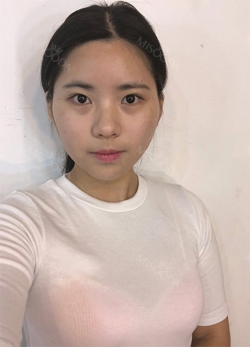 Double Eyelid Revision (Natural adhesion method+Ptosis correction+Dual Epi) + Nasal bridge + Nasal tip — Korea cost, reviews & before-after | MISOODA