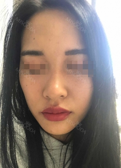 Rhinoplasty, Fat Grafting at BK Plastic Surgery — Korea cost, reviews & before-after | MISOODA