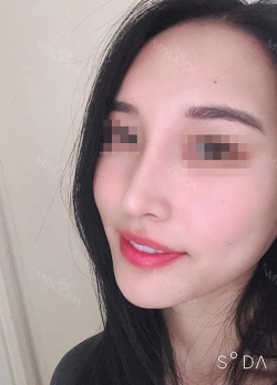 Rhinoplasty, Fat Grafting at BK Plastic Surgery — Korea cost, reviews & before-after | MISOODA
