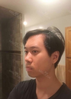 Double Eyelid Surgery, Chin Implant, Rhinoplasty — Korea cost, reviews & before-after | MISOODA