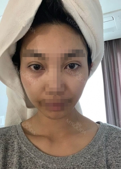 Zygomatic Bone Reduction, Under eye fat reposition — Korea cost, reviews & before-after | MISOODA