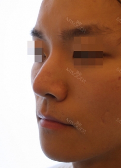 Nose surgery 3 months — Korea cost, reviews & before-after | MISOODA