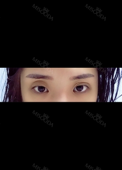 Double eyelids revision only 1 week at Topface! — Korea cost, reviews & before-after | MISOODA