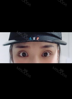 Double eyelids revision only 1 week at Topface! — Korea cost, reviews & before-after | MISOODA