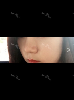 Consulting with the fanous nose revisioning clinic, O&Young — Korea cost, reviews & before-after | MISOODA