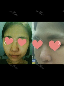 Nose Review! From a low bridge big nose to a desired nose!~~ — Korea cost, reviews & before-after | MISOODA
