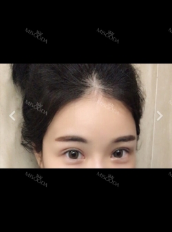 New double eyelids — Korea cost, reviews & before-after | MISOODA