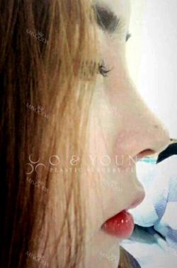 A very satisfied first time nose, I will not need any revision ~~~ — Korea cost, reviews & before-after | MISOODA