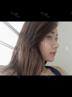Bye Bye an ugly nose — Korea cost, reviews & before-after | MISOODA