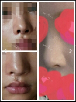 1 Week new eyes and nose with no bruise >< — Korea cost, reviews & before-after | MISOODA