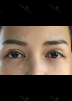 Review the 365000 costing eyes revision — Korea cost, reviews & before-after | MISOODA