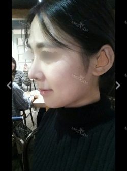 Nose Review! From a low bridge big nose to a desired nose!~~ — Korea cost, reviews & before-after | MISOODA