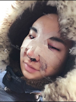 Expensive nose TT — Korea cost, reviews & before-after | MISOODA